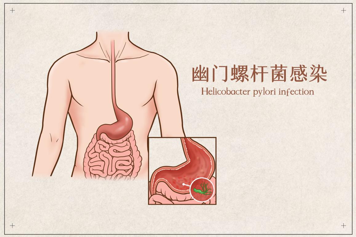 幽门螺杆菌精准治疗新突破，突破传统疗法迈向高效治疗时代